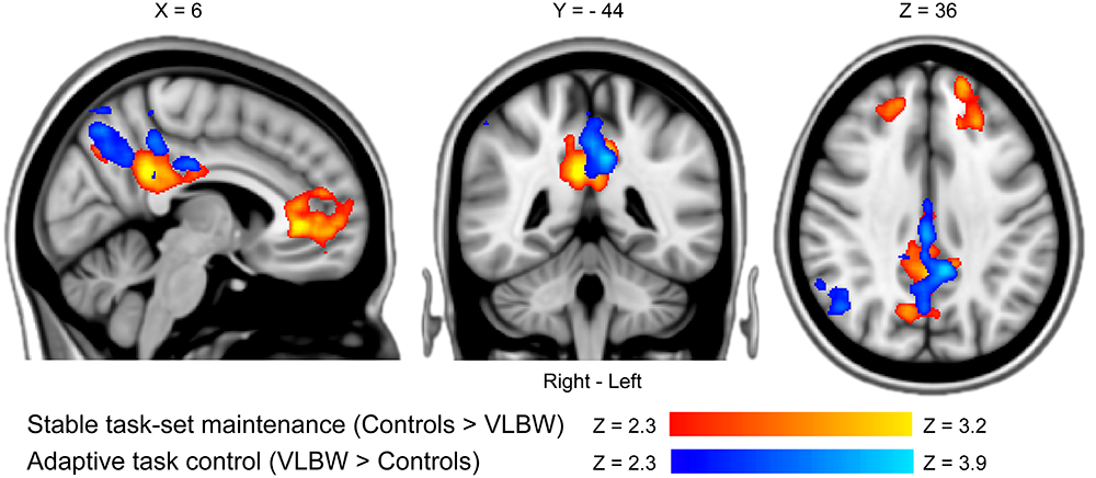 De oransje-gule områdene viser hvor personer med lav fødselsvekt hadde mindre proaktiv, kognitiv kontrollaktivering i hjernen. Blå-lyseblå områder viser hvor de hadde mer reaktiv, kognitiv kontrollaktivering sammenlignet med gruppen med normal fødselsvekt. Foto: Alexander Olsen/NeuroImage