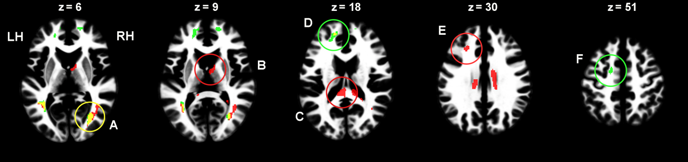 MR-scanning: Områdene som er ringet inn viser signifikante forskjeller i det nevrale nettverket i hjernene til høyrisikotakerne kontra lavrisikotakerne. Forskjellene var svært tydelige i seks områder av hjernen.