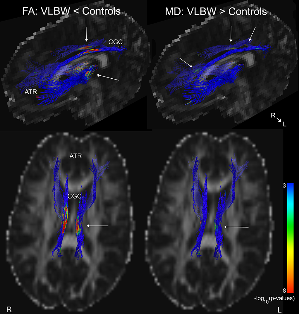 De blå fargene viser to hvit substansbaner i hjernen som er særlig viktige for kognitiv kontrollfunksjon.  Regioner i rødt/ grønt (og indikert med piler) viser deler av hjernen hvor personer med lav fødselsvekt hadde dårligere organisering av den hvite substansen sammenlignet med gruppen med normal fødselsvekt. Foto: Alexander Olsen/NeuroImage